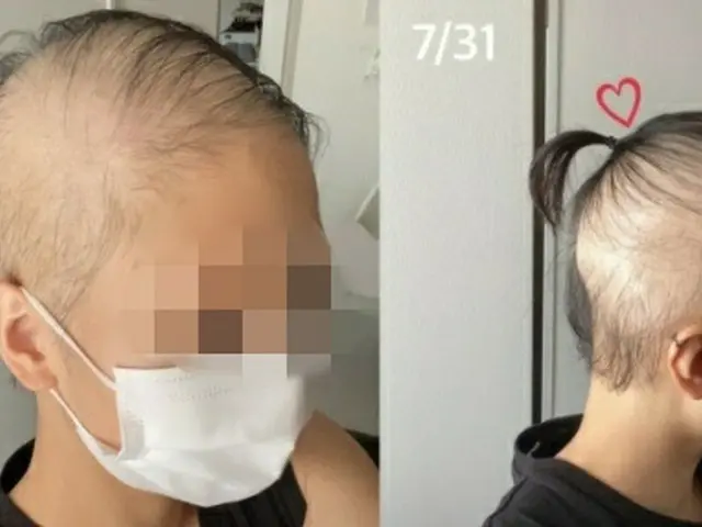 据韩国报道，一名二十多岁的日本女性在第一次接种 Moderna 疫苗后开始脱发