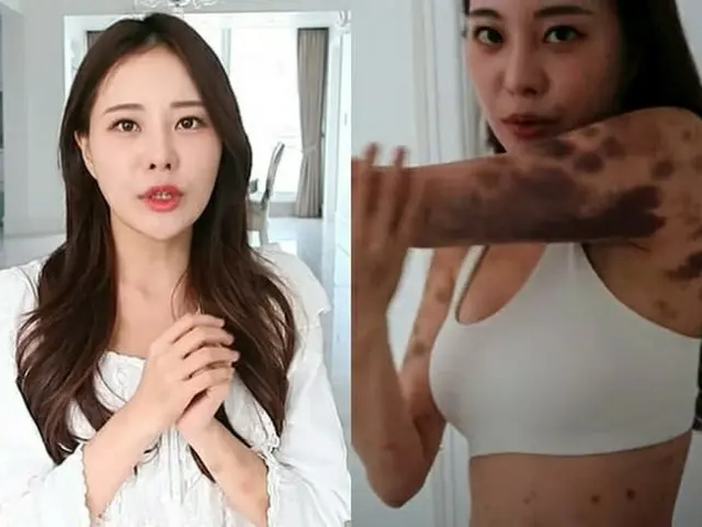 AORI 是一位美丽的 YouTube 用户，她透露注射促进健康的注射剂导致她全身出现“蓝色瘀伤”，并报告说她“正在努力康复”