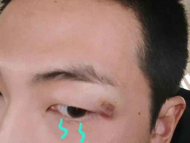 RM的粉丝在露出眉毛下的伤疤后很担心